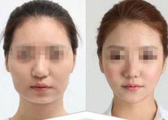 南寧市哪家醫(yī)院做雙眼皮好？