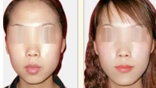 荊州哪個醫(yī)院能做隆鼻手術效果好？