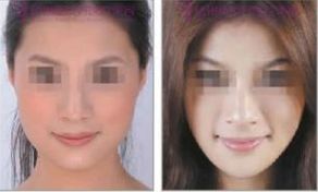 【2024最新】上海求美者首選的玻尿酸隆鼻醫(yī)院推薦