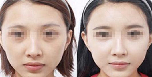 邯鄲哪家醫(yī)院做乳房整形效果好？