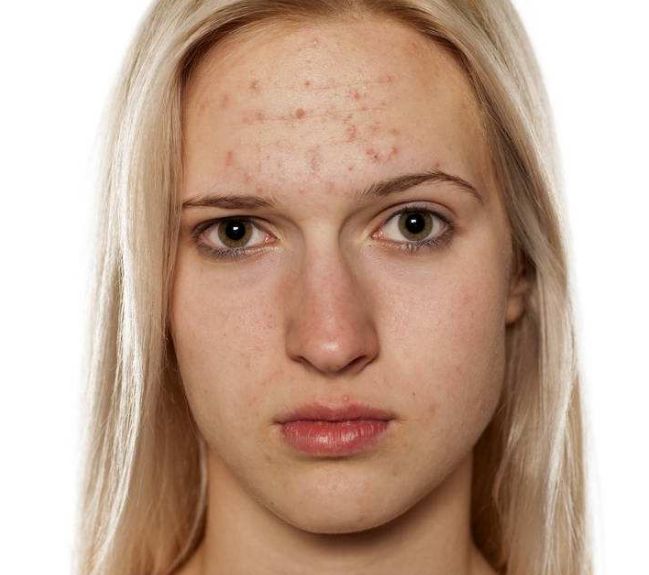 成都哪家醫(yī)院激光祛斑效果比較好？