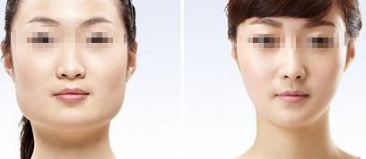 咸陽哪家醫(yī)院做雙眼皮好？醫(yī)院推薦！