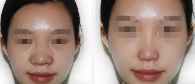 哈爾濱哪家醫(yī)院做隆鼻好？醫(yī)療技術(shù)排行幫你快速選擇