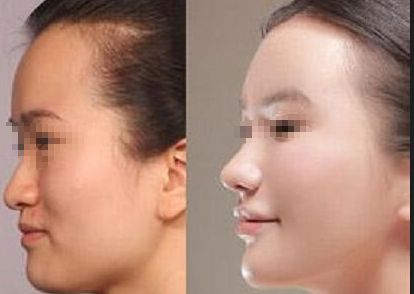 成都恒博植發(fā)效果如何？真實案例分享與價格分析