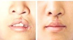 深圳雙眼皮醫(yī)院哪家專業(yè)醫(yī)師值得信賴？