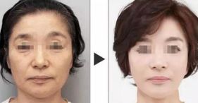 西安哪家醫(yī)院擅長面部輪廓整形？