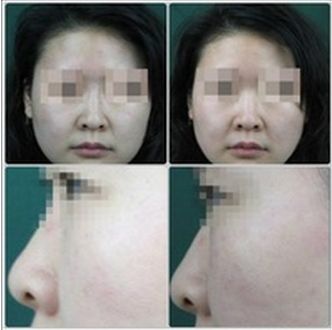 長春銘醫(yī)整形醫(yī)院雙眼皮手術(shù)效果及費用查詢