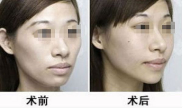 拉皮整形選擇趙絳波，打造無痕美顏，見證真實效果