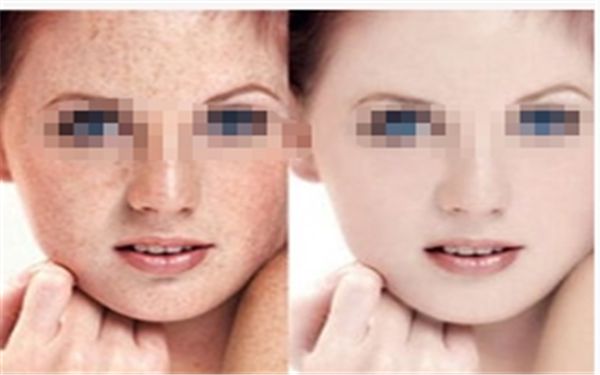 合肥哪家醫(yī)院近視激光手術(shù)靠譜？