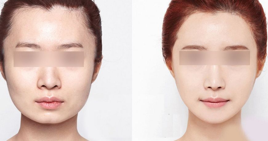 2024年南昌哪家醫(yī)院的唇部整形效果好呢？