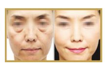 日照哪家醫(yī)院做雙眼皮手術(shù)技術(shù)高效？