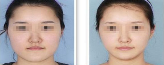 福州吸脂手術哪家醫(yī)院技術先進受用戶好評