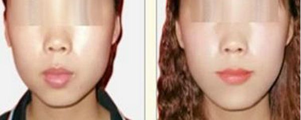 深圳哪家醫(yī)院祛斑效果較好？