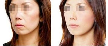 2024珠海雙眼皮手術(shù)醫(yī)院推薦，幫您預(yù)測前五家