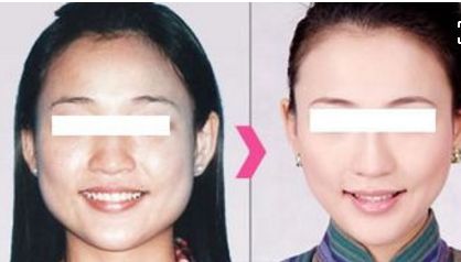 貴陽哪家醫(yī)院做自體脂肪豐蘋果肌比較好