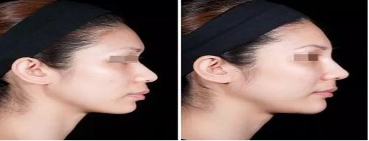 廣州哪家整形醫(yī)院祛痘效果比較好？去痘患者首選醫(yī)院排行榜