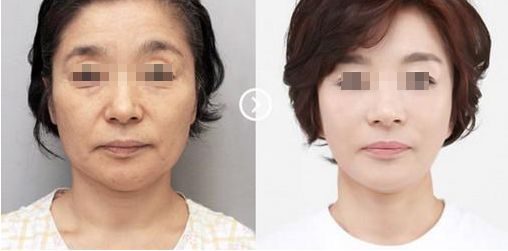 蘇州奧克拉醫(yī)院的整形效果及評價如何？