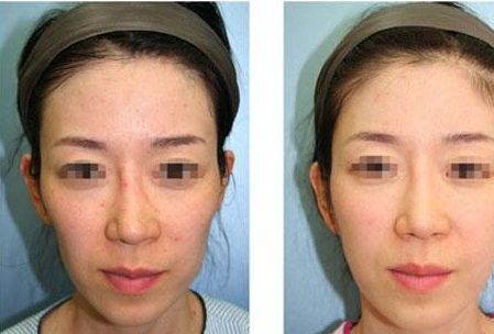 沈陽(yáng)鼻整形醫(yī)院排名前5，專家推薦！