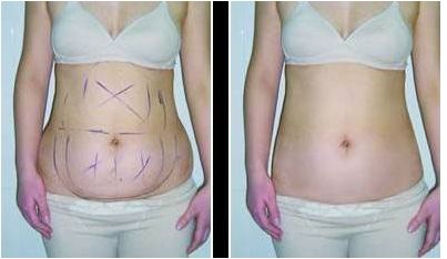 浙江哪家醫(yī)院做吸脂好？TOP10醫(yī)院推薦