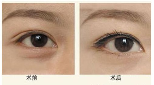 山東哪家醫(yī)院做膨體隆鼻效果好？