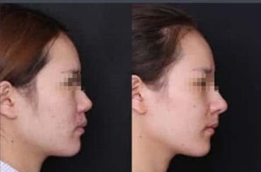 寧波哪家醫(yī)院做隆鼻手術(shù)效果好？