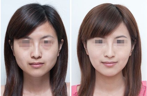 合肥哪家雙眼皮修復(fù)效果好？排名前十的整形醫(yī)院大揭秘