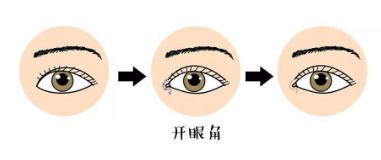 如何選擇適合自己的雙眼皮手術(shù)方法？