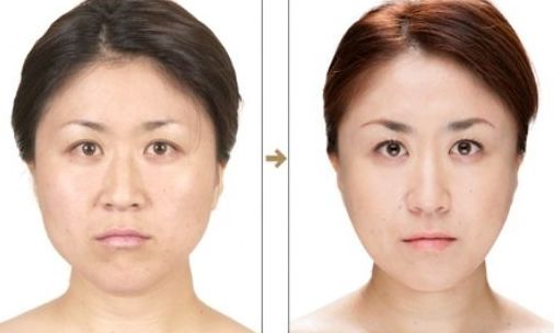 上海美聯(lián)臣吸脂怎么樣？真實案例告訴你答案！