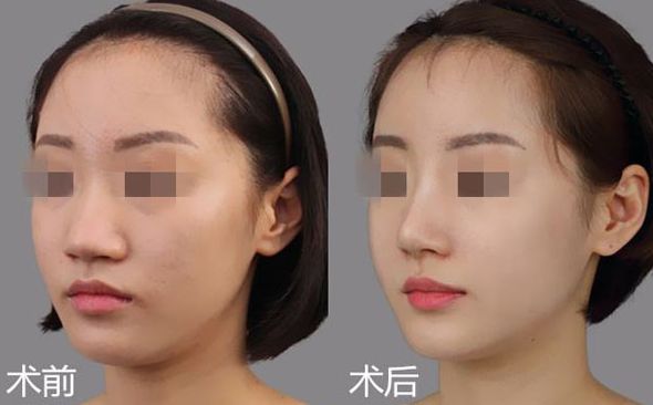 江門哪家醫(yī)院割雙眼皮效果好？