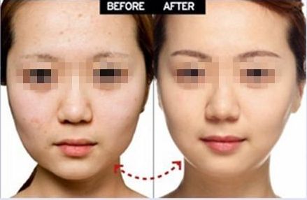 上海眼部整形醫(yī)院推薦，雙眼皮修復(fù)效果好