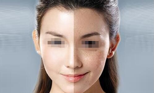 川美紫馨光子祛斑：專家詳解效果及注意事項