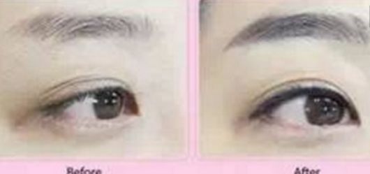 快速消腫！雙下巴吸脂術(shù)后恢復(fù)時長揭秘