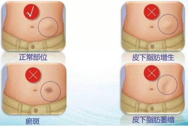 獲悉四川地區(qū)專業(yè)自體脂肪隆胸醫(yī)院，解決您的疑慮