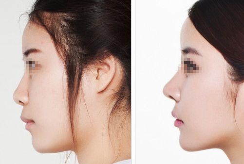 汕頭名流整形醫(yī)院：拉雙眼皮、吸脂價格一覽，專家解讀真實案例