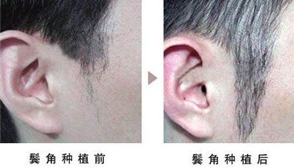 開眼角手術改善眼型，揭秘適合人群