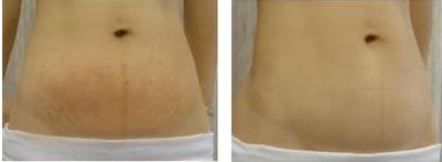 福州改善眼角皺紋醫(yī)生