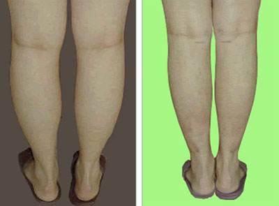 重慶線雕祛木偶紋醫(yī)生