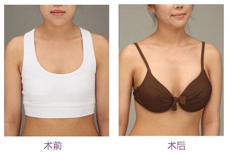 中山微電波拉皮除皺醫(yī)生