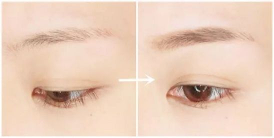 贛州自體脂肪注射印第安紋醫(yī)生