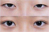 青島無痕微雕開眼角醫(yī)生