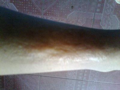 濱州玻尿酸豐上唇醫(yī)生