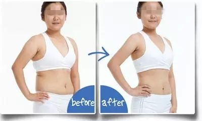 佛山傳統(tǒng)吸脂瘦后背醫(yī)生