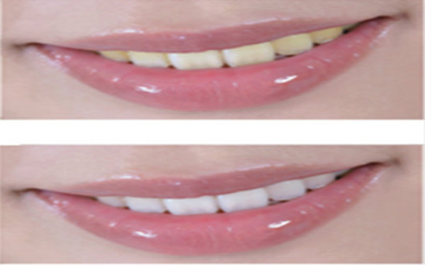 杭州去除雀斑皮秒祛斑醫(yī)生