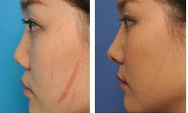 煙臺秒雕祛眼睛細紋醫(yī)生