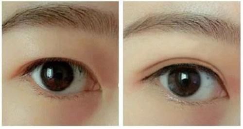 長沙嗨體去淚溝醫(yī)生