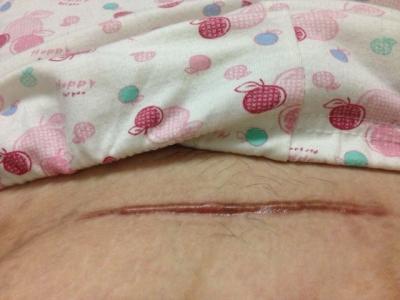 廈門胳膊吸脂醫(yī)生