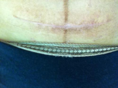 沈陽(yáng)下巴填充骨膠原醫(yī)生