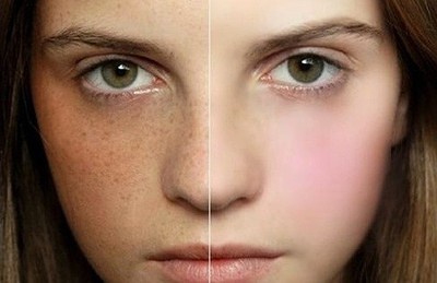 中山魚尾紋打玻尿酸醫(yī)生