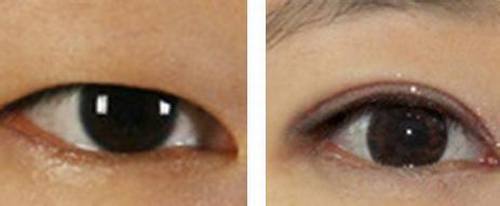 廈門去眼周紋手術(shù)醫(yī)生