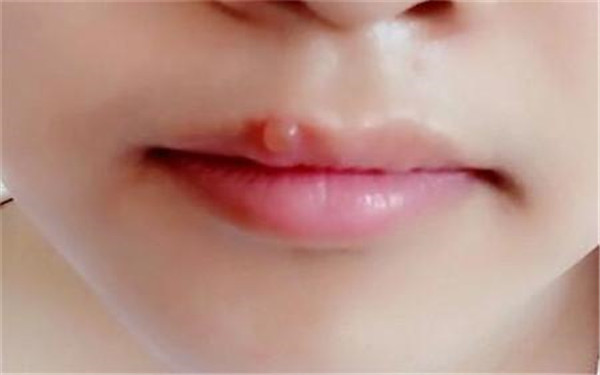 石家莊剝離眉間紋醫(yī)生